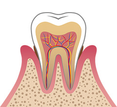 軽度の歯周炎