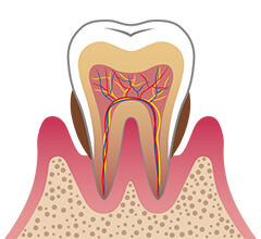 中等度の歯周炎
