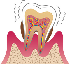 重度の歯周炎