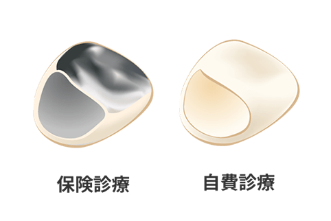 険診療の素材・自費診療の素材の違い