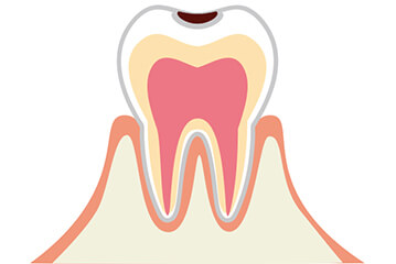 初期の虫歯