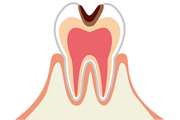歯の内部まで進行した虫歯