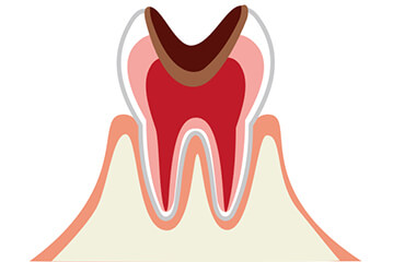神経まで進行した虫歯