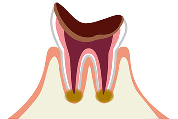 根の部分だけが残った虫歯